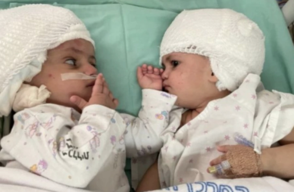 Emotivni susret sestara – prvi put se videle: Uspešno razdvojene sijamske bliznakinje! (VIDEO)