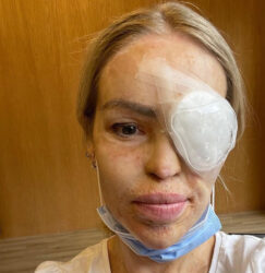 DEČKO JE ZLOSTAVLJAO OSAM SATI: Fotomodelu prosuo kiselinu na lice, imala 400 operacija, danas ima porodicu i izgleda OVAKO!