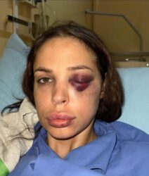 NADAM SE DA ĆE TAJ OLOŠ DOBITI ŠTA ZASLUŽUJE: Nataša Šavija se oglasila iz bolnice i pokazala lice (FOTO)