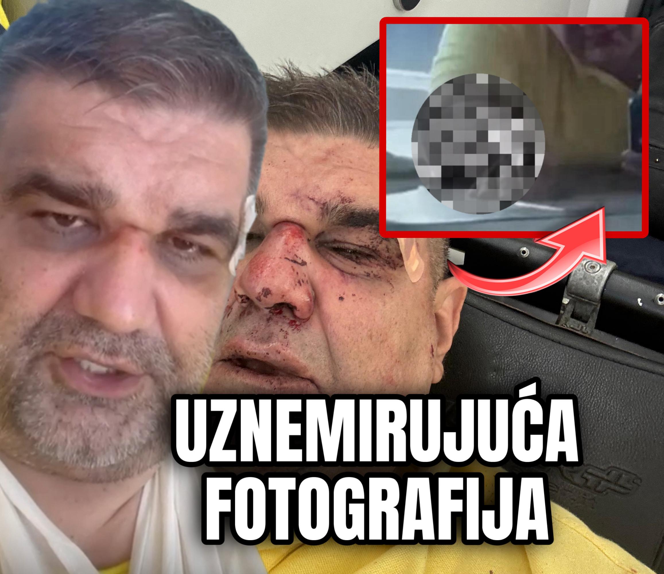 UZNEMIRUJUĆE NECENZURISANE SLIKE: Evo kako je izgledala IZDEFORMISANA SMRSKANA RUKA Saše Mirkovića nakon pokušaja ubistva I MUČKOG ŠUTIRANJA ispred hotela u Zagrebu