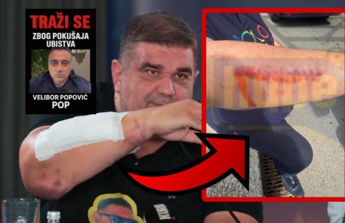 (OPREZ) UZNEMIRUJUĆE FOTOGRAFIJE IZMASAKRIRANE RUKE SAŠE MIRKOVIĆA: Evo kako izgleda RUKA čelnika Hype televizije nakon KRVNIČKOG POKUŠAJA UBISTVA