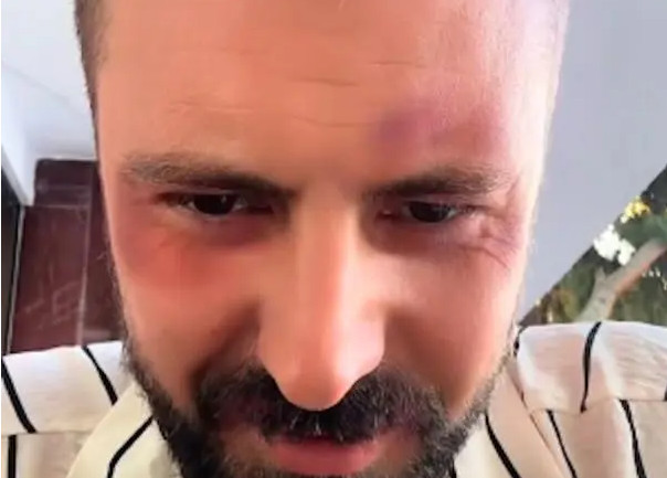 PRETUČEN BIVŠI RIJALITI UČESNIK! Oglasio se sav u modricama: „Napala su me PETORICA“