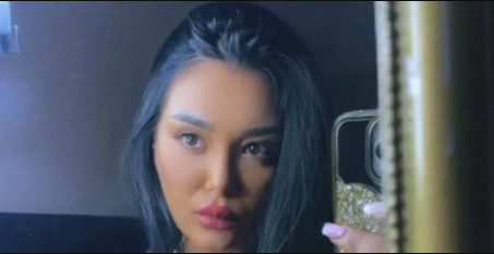 INFLUENSERKI BOTOKS IZDEFORMISAO LICE! Nakon tretmana izgleda kao da je IZUJEDAO ROJ PČELA! (FOTO)